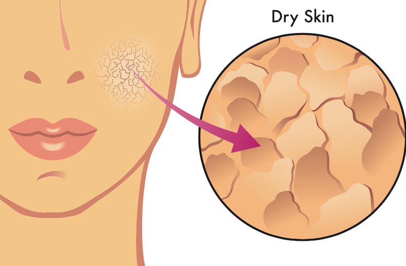Woman with dry skin